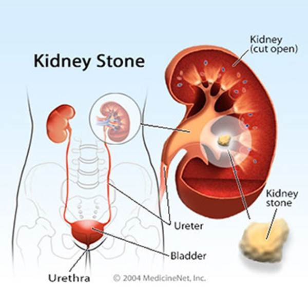 Factors that contribute to kidney disease